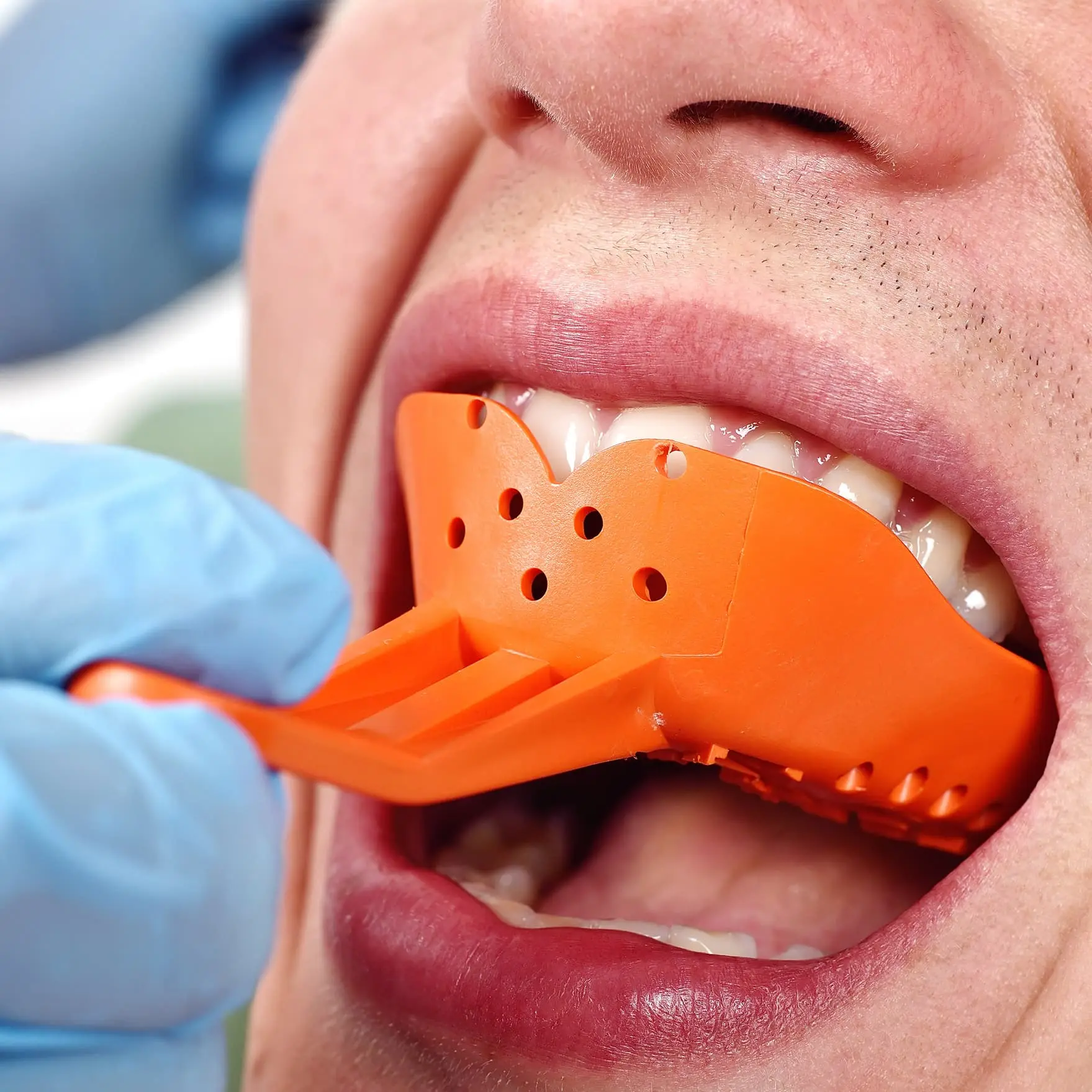 Lấy dấu răng tạo cơ sở để chế tác răng sứ khít hoàn hảo